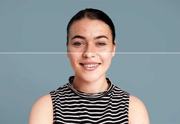 Acne Treatment at AZ Esthetics