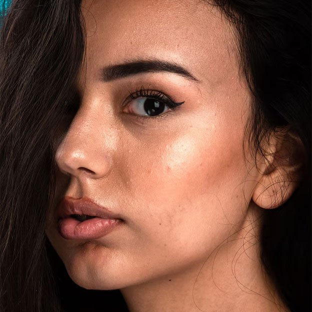 Hyperpigmentation & Melasma