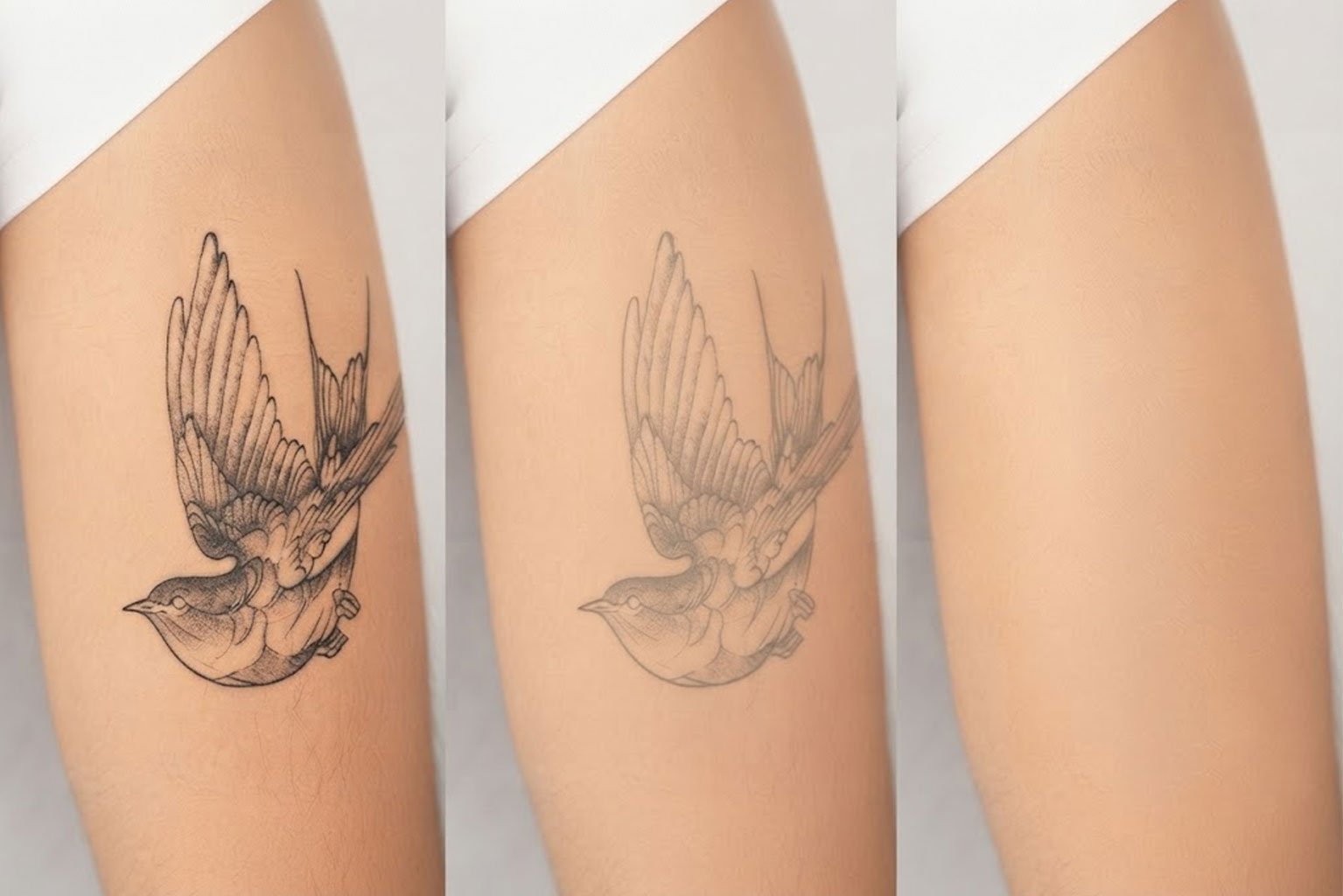 Tattoo before laser removal treatment